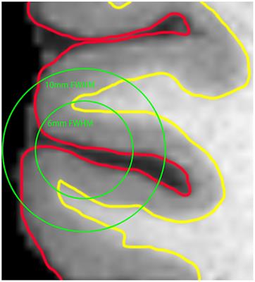 Altered Spontaneous Brain Activity in Subjects With Different Cognitive States of Biologically Defined Alzheimer's Disease: A Surface-Based Functional Brain Imaging Study